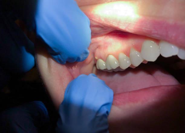 Best Emergency Dental Care for Broken or Chipped Teeth in North Fort Lewis, WA