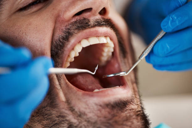 Best Emergency Tooth Extraction in North Fort Lewis, WA
